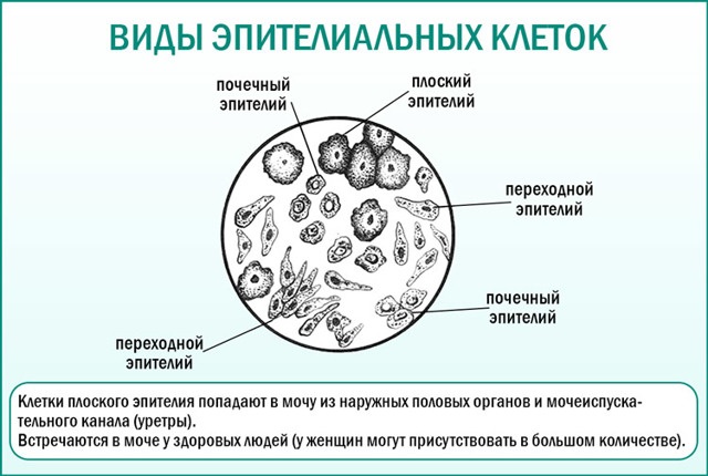 Эпителий плоский в моче повышен у женщин при беременности, ребенка, мужчин. Что это значит, причины, лечение