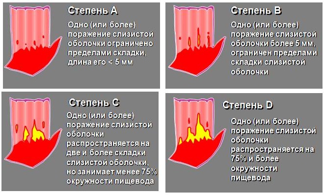 Гастро-эзофагеально-рефлюксная болезнь. Симптомы и лечение