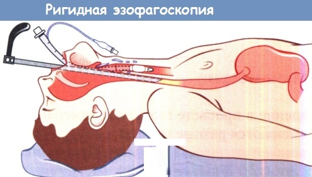 Гастро-эзофагеально-рефлюксная болезнь. Симптомы и лечение