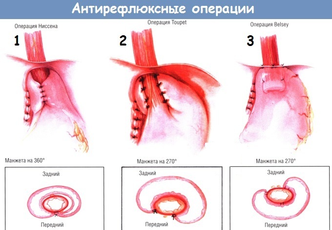 Гастро-эзофагеально-рефлюксная болезнь. Симптомы и лечение