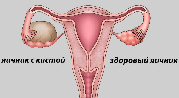 Фолликулы в яичниках. Норма количество в 30-40-50 лет, при беременности, менопаузе, размеры