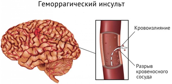 Микроинсульт у молодых девушек. Симптомы, возраст, лечение