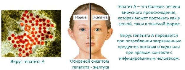 Симптом Кернига и Брудзинского при менингите, ОНМК, паркинсоне, инсульте. Что это такое, как проверить
