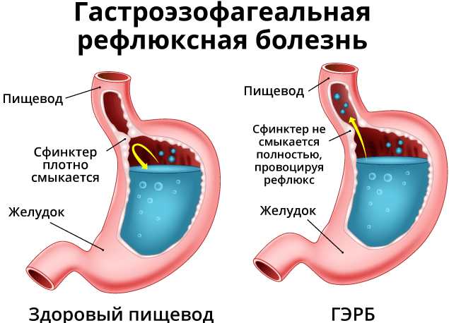 Гастро-эзофагеально-рефлюксная болезнь. Симптомы и лечение
