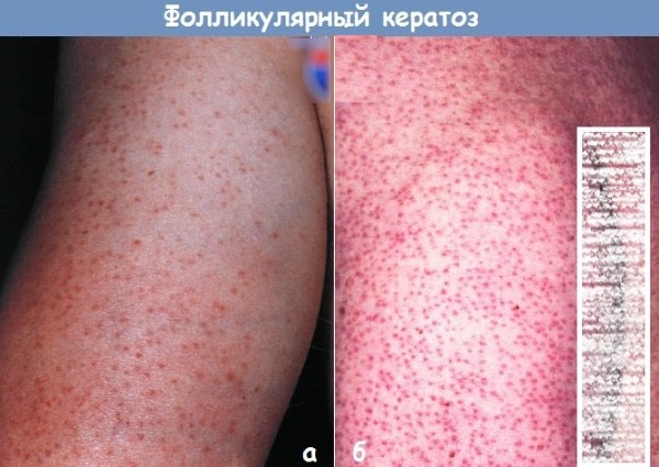 Гиперкератоз. Что это такое, причины, симптомы и лечение. Виды, стадии, фото