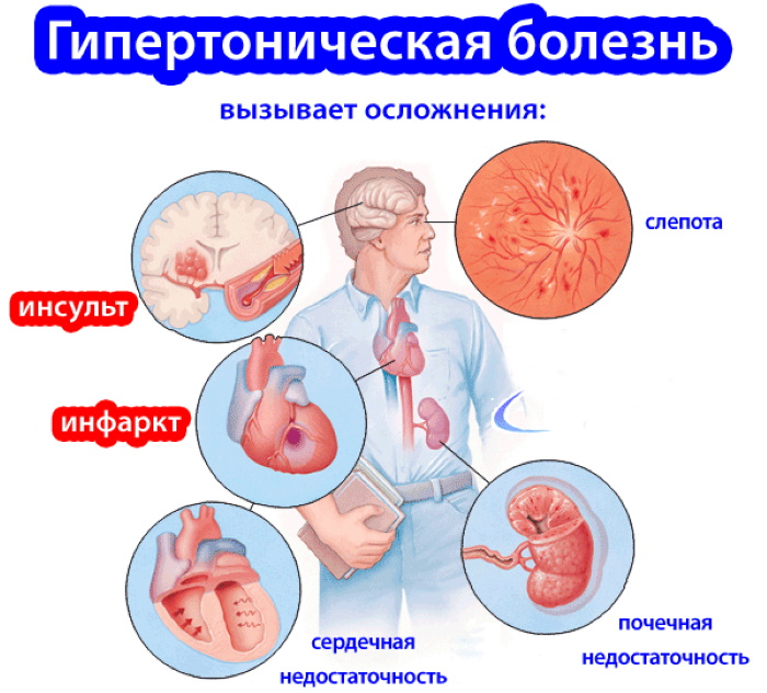 Гипертоническая болезнь. Стадии, степени, риски, причины и лечение, клинические рекомендации