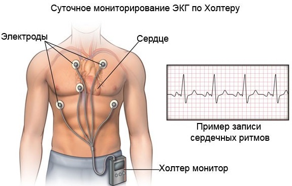 Гипертонический криз. Что это такое, причины, классификация, неотложная помощь, лечение