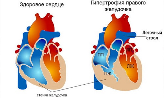 Гипертрофия правого желудочка на ЭКГ. Признаки, лечение