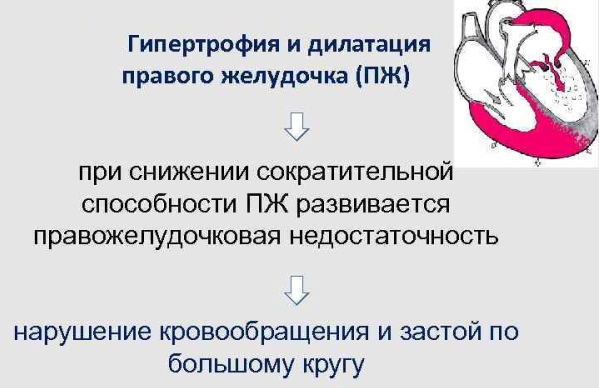 Гипертрофия правого желудочка на ЭКГ. Признаки, лечение