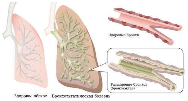 Гипертрофия правого желудочка на ЭКГ. Признаки, лечение