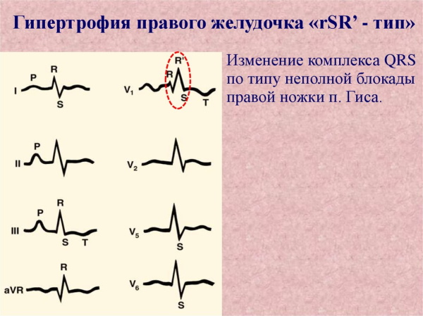 Гипертрофия правого желудочка на ЭКГ. Признаки, лечение