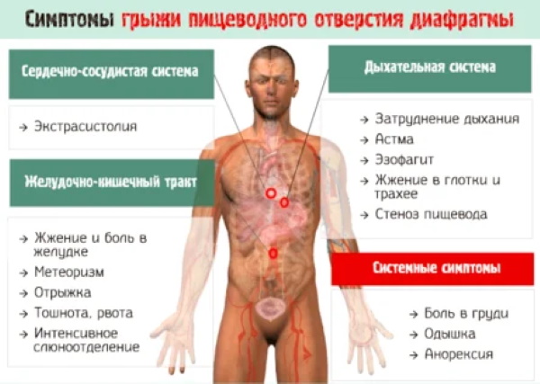 ГПОД (грыжа пищеводного отверстия диафрагмы). Симптомы и лечение