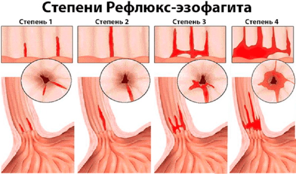 ГПОД (грыжа пищеводного отверстия диафрагмы). Симптомы и лечение