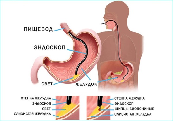 Грыжа пищевода. Лечение без операции народными средствами, диета