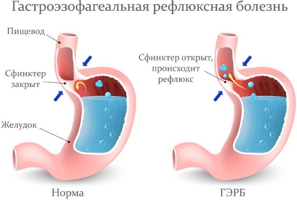 Грыжа пищевода. Лечение без операции народными средствами, диета