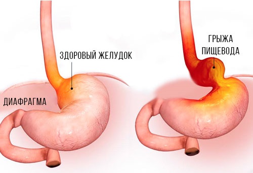 Грыжа пищевода. Лечение без операции народными средствами, диета