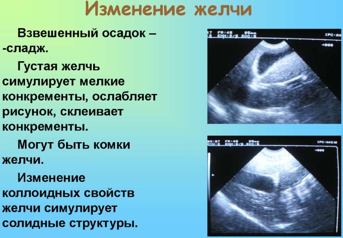 Густая желчь. Причины и лечение, симптомы, что делать, лекарства, диета