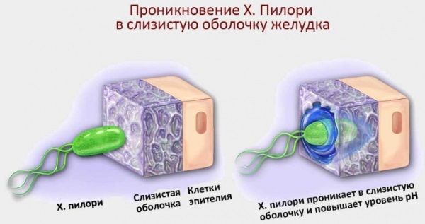 Хеликобактер пилори. Симптомы, как передается, схема лечения, лекарства, народные средства, анализы