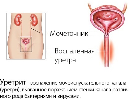 Инфекция мочевыводящих путей у детей. Симптомы, причины, лечение
