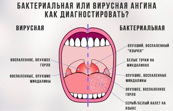 Хлоргексидин для полоскания рта, горла, десен. Инструкция, как разводить