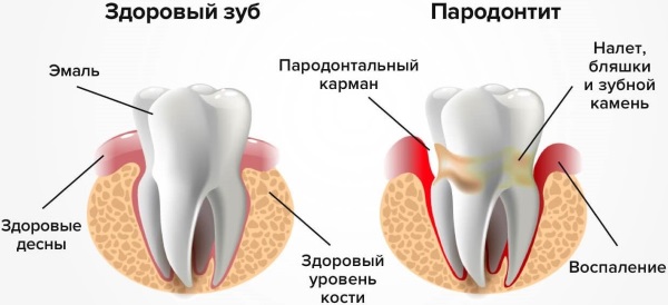 Хлоргексидин для полоскания рта, горла, десен. Инструкция, как разводить