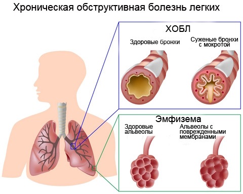 Экспираторная одышка. Что это такое, для чего характерна, признак чего, лечение