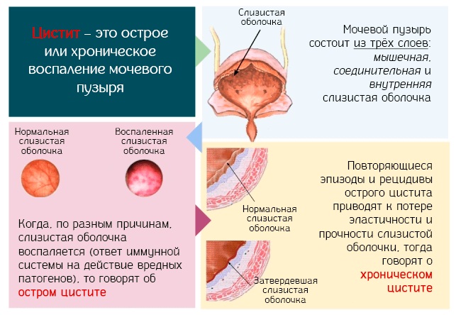Эндометриоз. Симптомы и лечение у женщин народными средствами, травами, гормональными препаратами, гомеопатией, таблетки, свечи. Признаки, причины, прогноз
