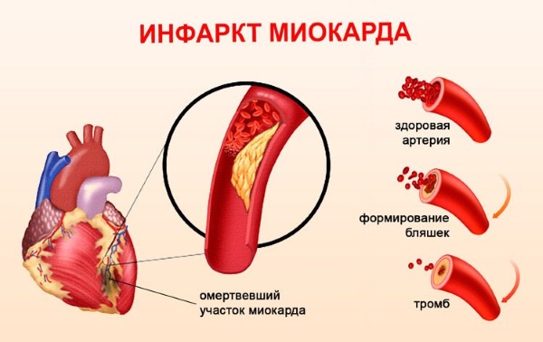Инфаркт у женщин до 40, старше 50-60 лет. Симптомы, последствия, восстановление организма