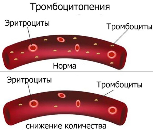 Инфекционный мононуклеоз у детей. Симптомы, лечение, клинические рекомендации, последствия