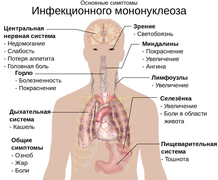 Инфекционный мононуклеоз у детей. Симптомы, лечение, клинические рекомендации, последствия