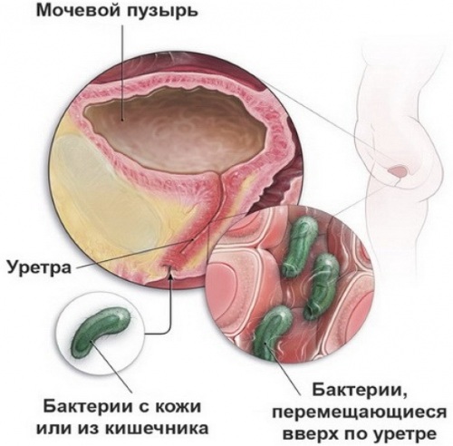 Инфекция мочевыводящих путей у детей. Симптомы, причины, лечение