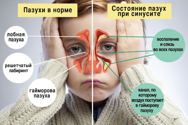Ингалипт для детей. Инструкция по применению, как применять до года, после 2-3 лет