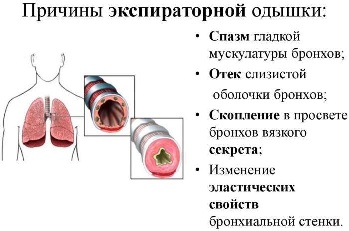 Инспираторная одышка. Характерна для чего, что это такое, заболевания