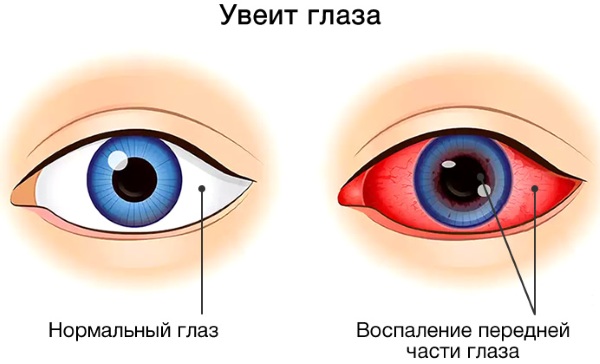Ципромед (Cipromed) глазные капли. Цена, инструкция по применению, аналоги