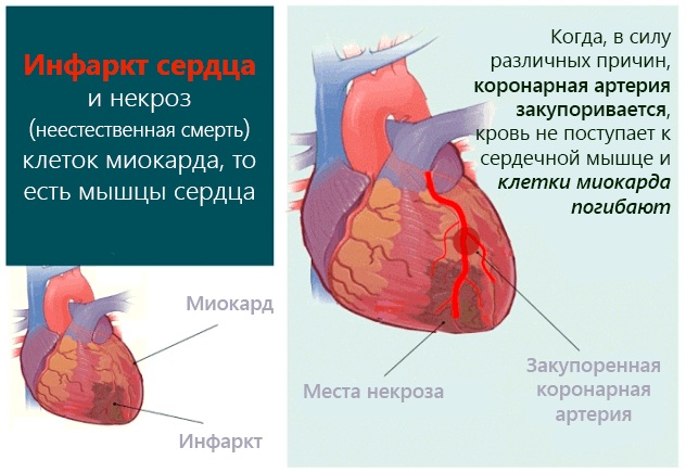 Замедление внутрипредсердной проводимости. Признаки на ЭКГ, причины, лечение