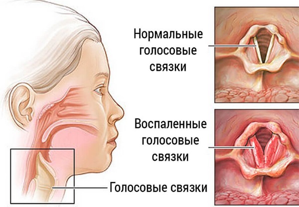 Как лечить осипший голос у взрослого. Народные средства, медикаменты, гомеопатия