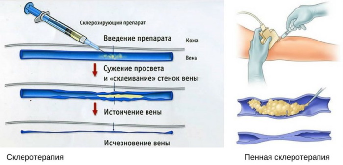 Капиллярная сетка на ногах. Как избавиться, мази, крем, таблетки, лазером