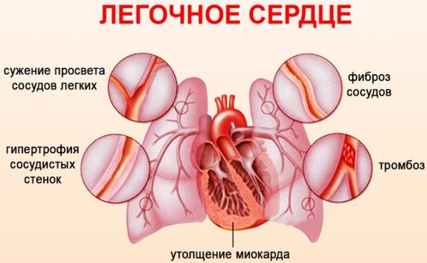 Кардиомегалия на рентгенограмме у взрослого. Что это, сколько проживет