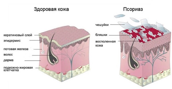 Цветной лишай у человека. Фото, признаки, стадии, лечение народными средствами, препараты
