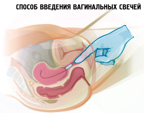 Клотримазол (Clotrimazolum) свечи при беременности 1-2-3 триместр. Инструкция по применению, аналоги
