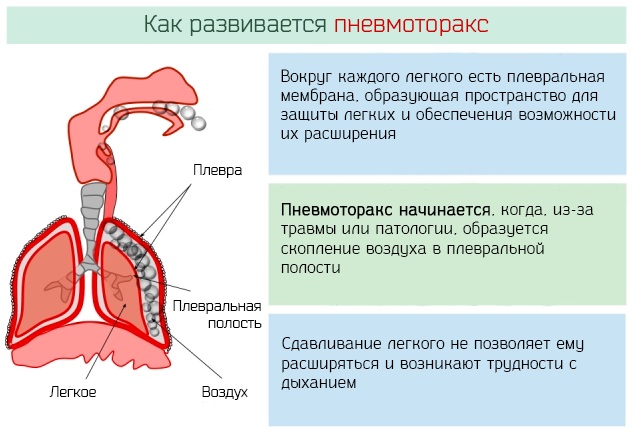 Диф. диагностика инфаркта миокарда. Таблица