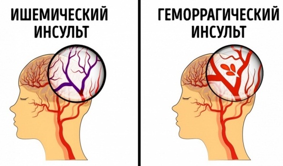 Компресс Димексид с Новокаином. Пропорции, состав, инструкция, как применять для суставов, местного обезболивания