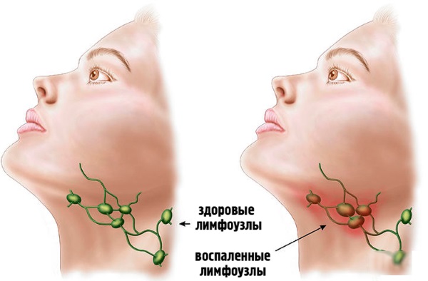 Прививка от кори, краснухи, паротита. График, как переносится, побочные эффекты