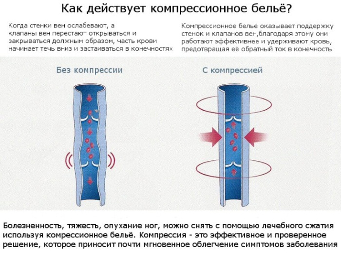 Компрессионные чулки 1, 2 класс для операции, беременных, после родов, для мужчин. Как выбрать размер, надевать, носить, стирать