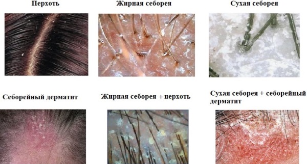 Корка на голове у взрослого. Как лечить перхоть под волосами, если кожа сухая, чешется