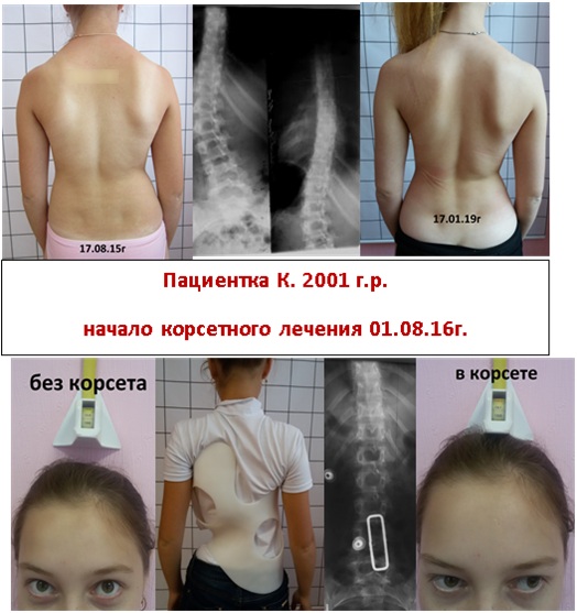 Корсет Шено для позвоночника при сколиозе 2-3-4 степени, кифозе