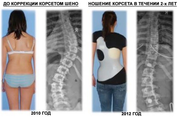 Корсет Шено для позвоночника при сколиозе 2-3-4 степени, кифозе