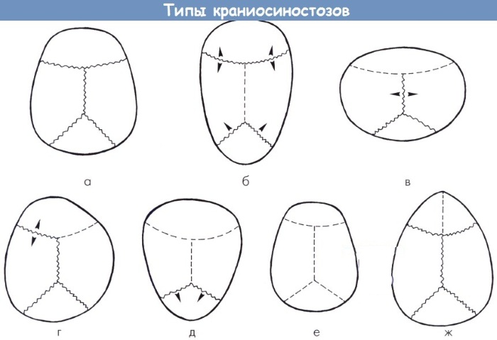 Краниостеноз (краниосиностоз) у детей, взрослых. Что это такое, симптомы, клинические рекомендации