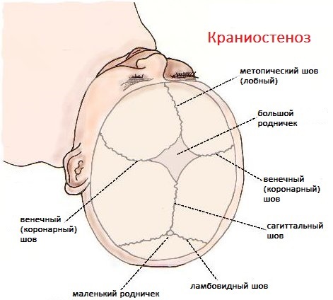 Краниостеноз (краниосиностоз) у детей, взрослых. Что это такое, симптомы, клинические рекомендации
