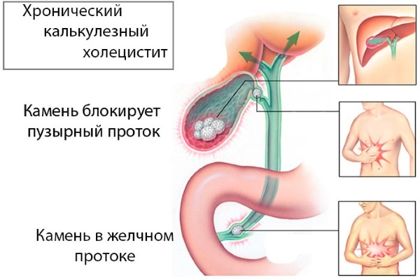 Дискенизия желчегонных путей у детей. Симптомы и лечение